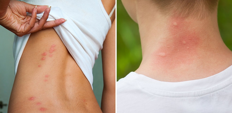 A woman pulling up her shirt to reveal bed bug bites, and a close-up of person's neck visible red and swollen from mosquito bites.