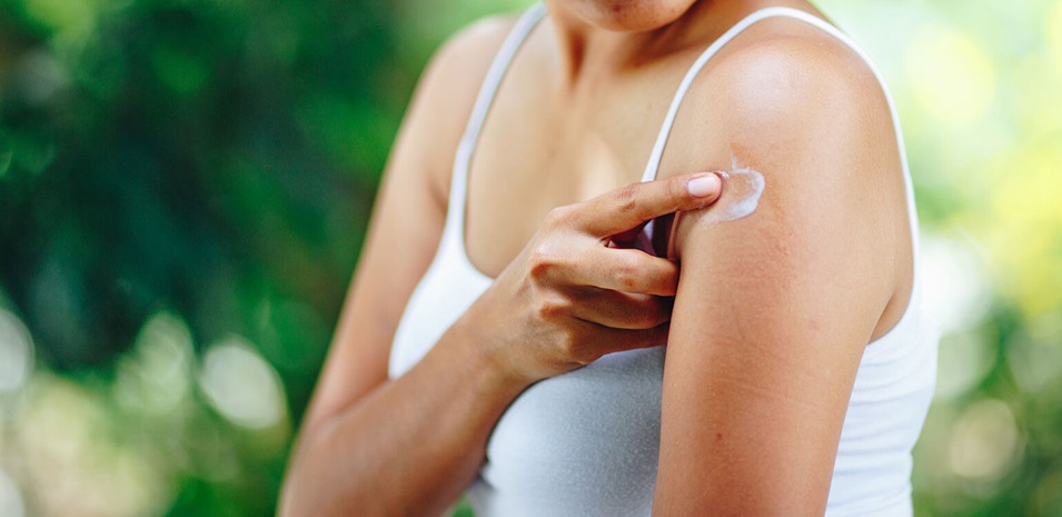A young woman applying an anti-itch lotion to a mosquito bite on her arm.